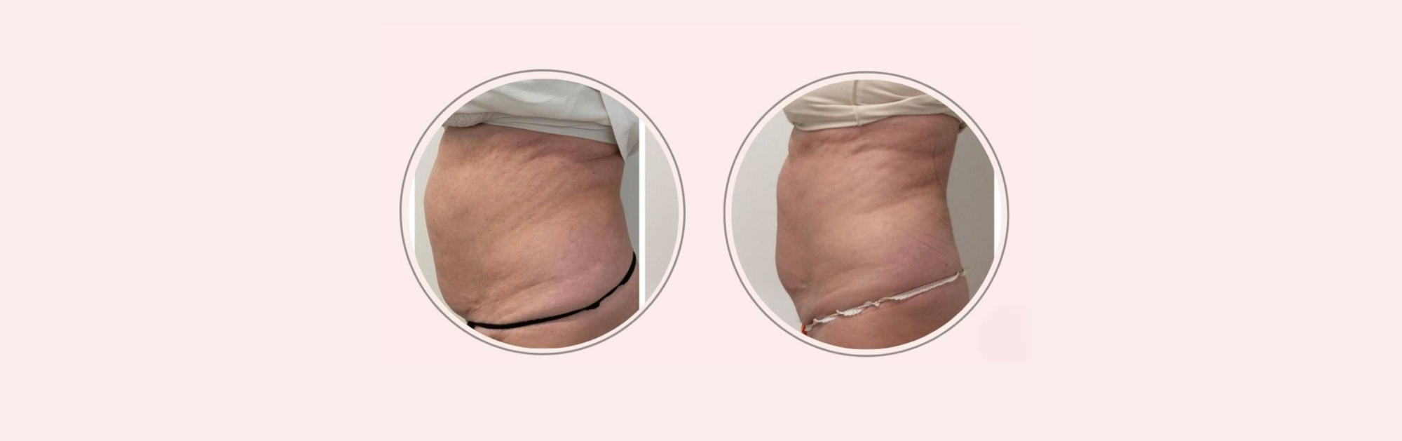 Come ridurre la pancia dopo i 70 anni: il percorso di Carla