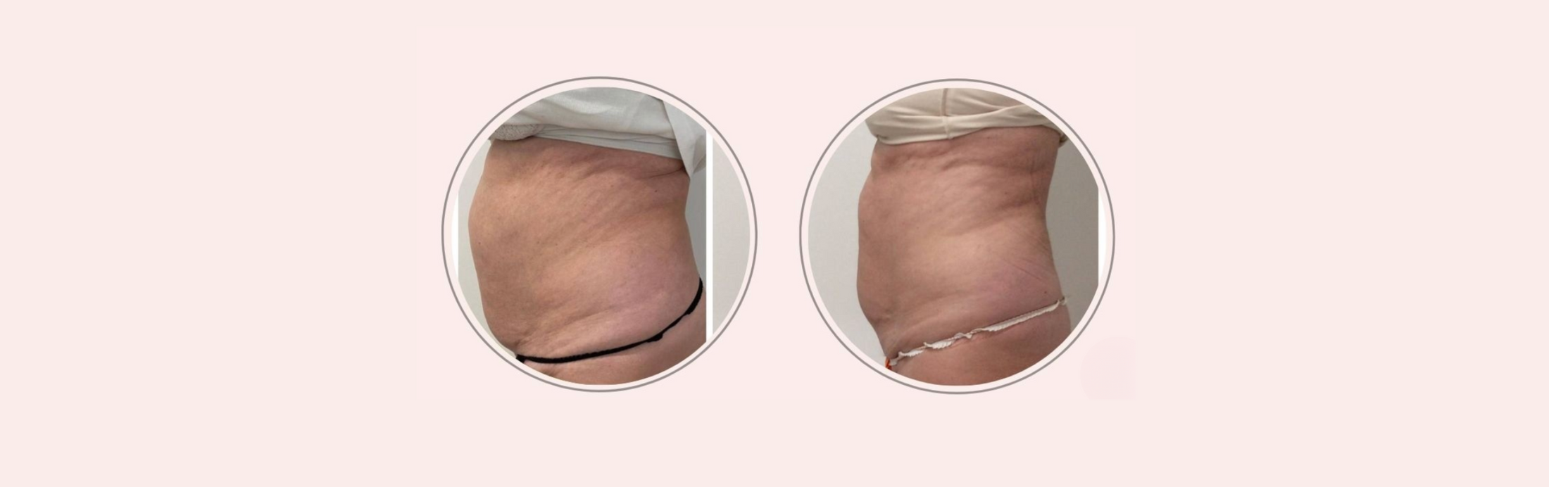 Come ridurre la pancia dopo i 70 anni: il percorso di Carla