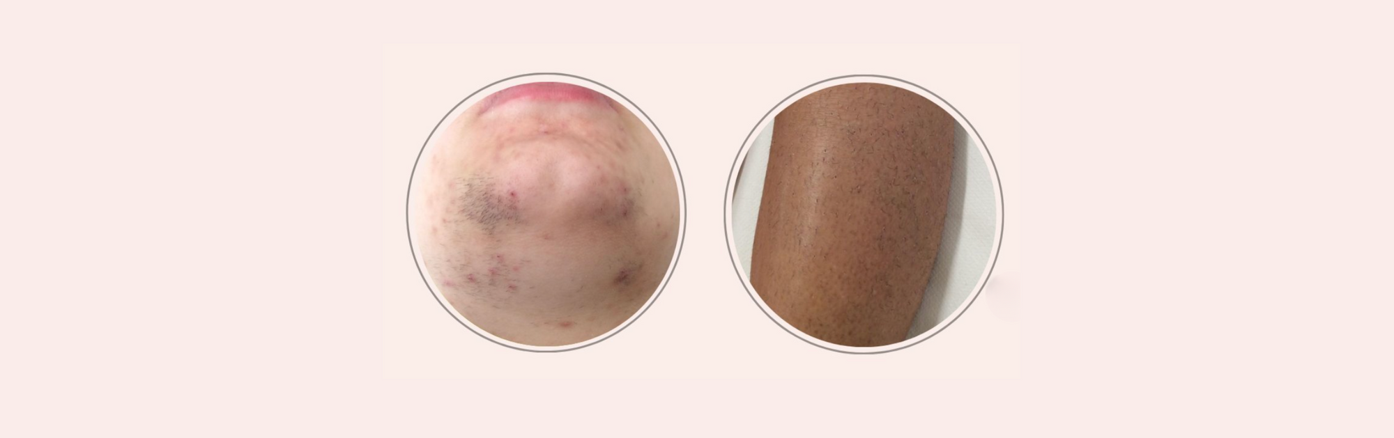 Epilazione laser definitiva: sicurezza, tecnologia avanzata e risultati garantiti