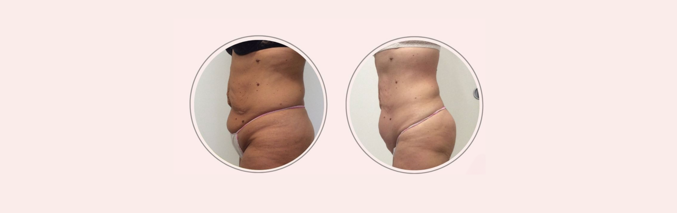 Radiofrequenza corpo per rimodellare e rassodare: il percorso di Stefania