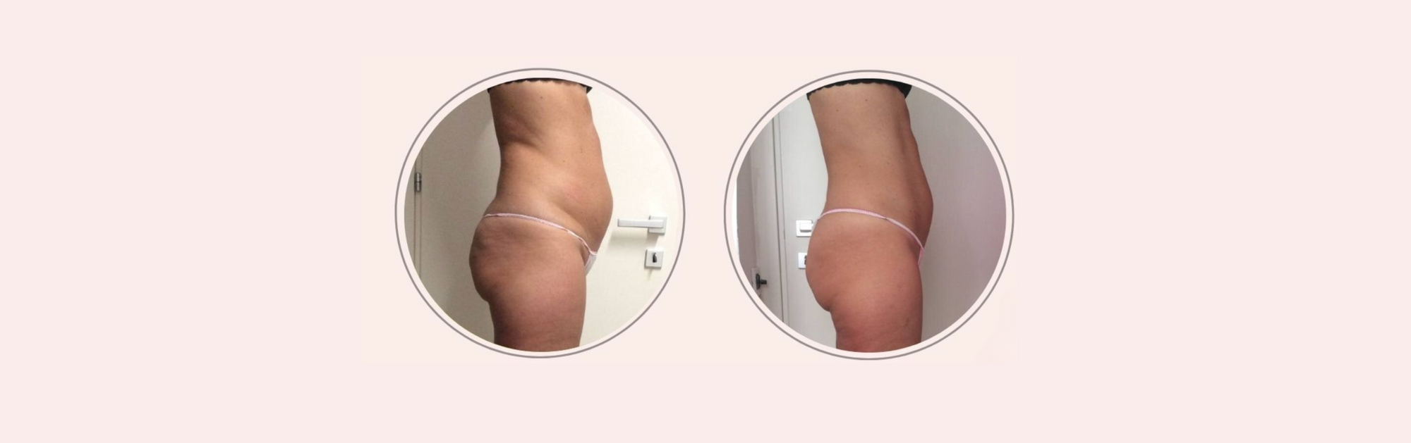 Rimodellamento corpo a 50 anni: il percorso di Anna