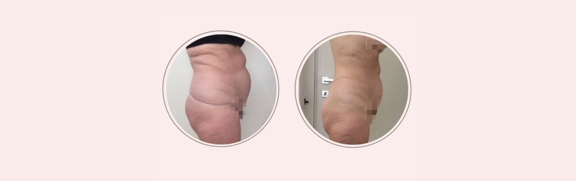 Trattamenti corpo per donne over 70: il cambiamento di Isabella