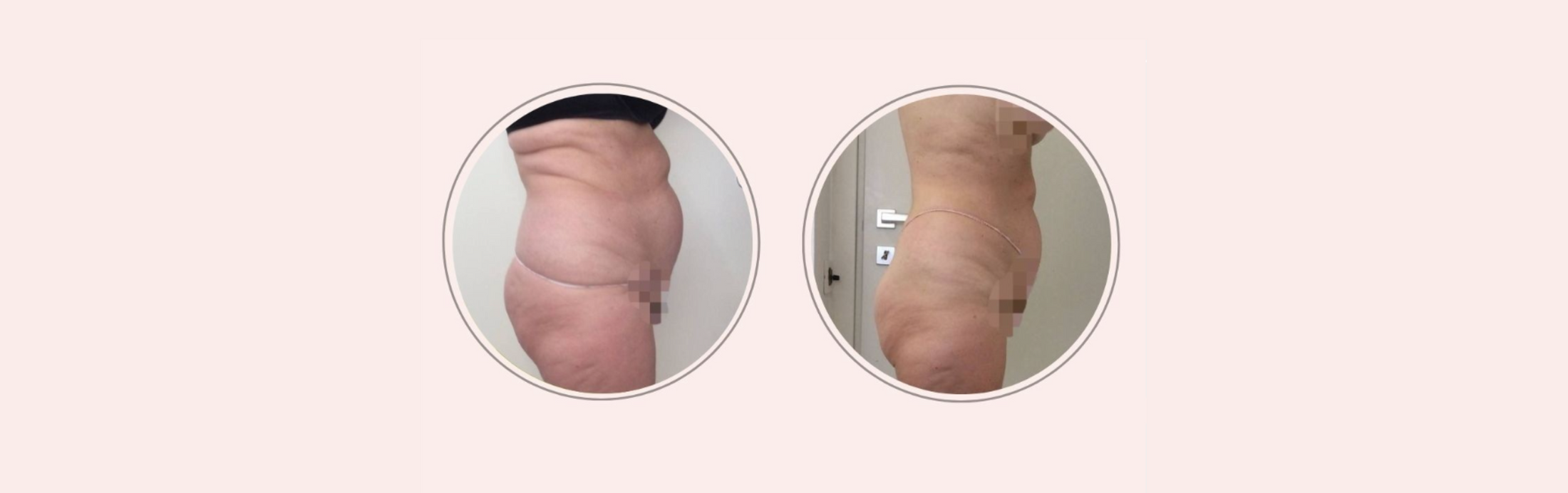 Trattamenti corpo per donne over 70: il cambiamento di Isabella