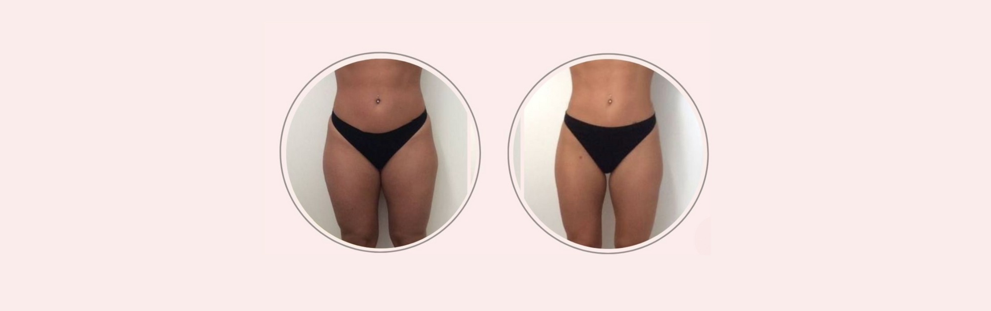 Trattamenti estetici per rimodellare le gambe: il percorso di Claudia